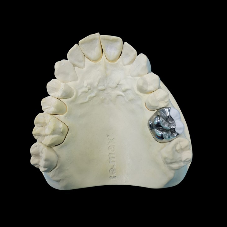 Metal Inlay Or Onlay